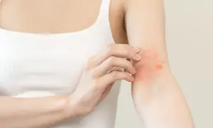 Frau kratzt sich am Arm mit rotem Ausschlag. Sie sucht nach Hausmittel gegen Juckreiz.
