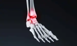 Anatomie du pied humain, mettant en évidence l'astragale os et les zones enflammées en rouge.