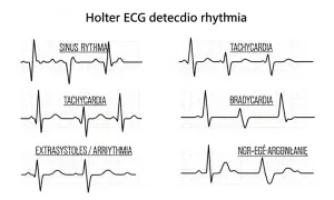 Przykłady zapisu EKG z monitorowania Holterem: rytm zatokowy, tachykardia, bradykardia, ekstrasystole, arytmia.