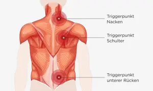 Muskelansicht des Rückens mit markierten Triggerpunkten im Nacken, an der Schulter und im unteren Rücken, die auf hws myogelose hinweisen.