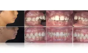 Prima e dopo: profilo di un bambino con apparecchio denti sporgenti e immagini ravvicinate dei suoi denti prima e dopo il trattamento ortodontico.