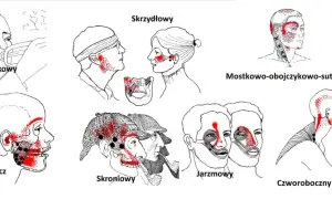 Ilustracje pokazują punkty bólu związane ze stawem skroniowo-żuchwowym. Różne obszary głowy i szyi zaznaczone czerwonymi kropkami wskazują potencjalne źródła bólu.