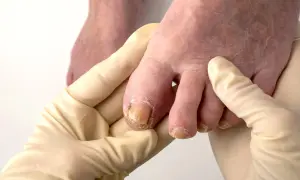 Hände in Handschuhen untersuchen Zehen mit verdickten, verfärbten Nägeln. Nagelpilz ist ansteckend und erfordert Behandlung.