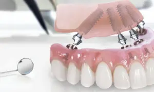 Model szczęki z implantami, gotowy do montażu. Rozważ implanty w Turcji dla pięknego uśmiechu.
