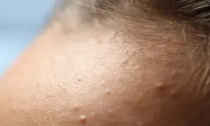 Zbliżenie na czoło z widocznymi grudkami na twarzy i włosami.