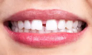 Primo piano di labbra con rossetto rosa e un diastema tra i denti anteriori, che illustra il diastema significato.