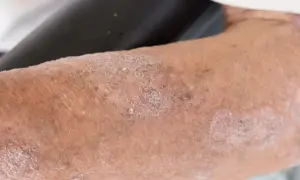 Skóra z widocznymi zmianami, łuszczeniem i zaczerwienieniem, sugerującymi problem dermatologiczny, być może orungal.