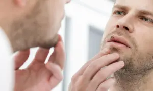 Mężczyzna z opryszczką na ustach zastanawia się, czy przeziębienie a znieczulenie u dentysty to problem.