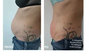 Przed i po zabiegu liposukcja kawitacyjna. Widoczna redukcja tkanki tłuszczowej na brzuchu po 1 zabiegu.