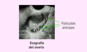 Ecografía ovárica que muestra varios folículos antrales, identificados con números del 1 al 4.