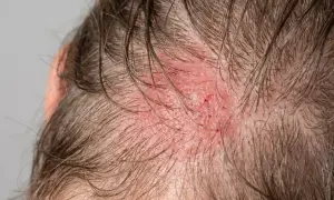 Rote, gereizte Kopfhaut mit kleinen Kratzern. Suche nach aufgekratzte Haut Hausmittel, um Linderung zu finden.