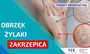 Jak zapobiec zakrzepicy? Skuteczna profilaktyka krok po kroku