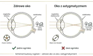 Astygmatyzm a prawo jazdy: zdrowe oko skupia światło na siatkówce, dając ostry obraz. Oko z astygmatyzmem tworzy dwa ogniska, co może wpływać na widzenie podczas prowadzenia pojazdu.