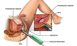 Badanie prostaty u urologa: Przebieg, przygotowanie i co musisz wiedzieć?