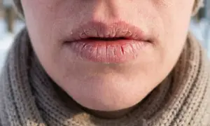 Zimno sprawia, że usta są suche i piekące, z widocznymi pęknięciami i łuszczącą się skórą.