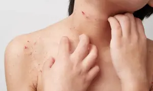 Haut mit roten Flecken und Kratzern, die auf starken Juckreiz hindeuten. Eine Hand kratzt sich am Hals und an der Schulter.