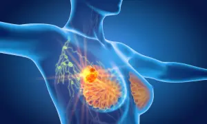 Model anatomiczny ukazujący skupisko komórek rakowych w piersi i węzły chłonne pod pachą, które mogą powodować ból pod pachą.