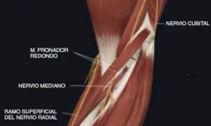 Edema muscular pronador redondo: ¿Por qué duele tu antebrazo?
