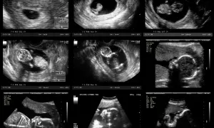 Badania prenatalne 2 trymestr: Twój przewodnik po zdrowiu dziecka