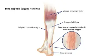 Anatomia łydki z zaznaczonym ścięgnem Achillesa i jego degeneracją. Ból łydek może być objawem problemów ze ścięgnem.