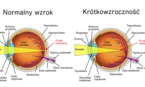 Porównanie budowy oka z normalnym wzrokiem i krótkowzrocznością. Ćwiczenia na poprawę wzroku mogą pomóc w zrozumieniu mechanizmów widzenia.