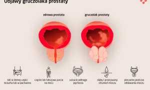 Porównanie zdrowej prostaty i gruczolaka. Objawy raka prostaty: ból brzucha, częste parcie na mocz, słaby strumień, pieczenie.