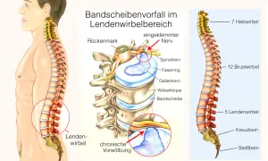 Illustration zeigt Bandscheibenvorfall im Lendenwirbelbereich, der Bandscheibenvorfall schmerzen im bein lindern kann. Eingeklemmter Nerv wird rot markiert.