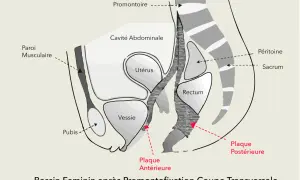 Coupe transversale du bassin féminin montrant la convalescence après promontofixation, avec utérus, vessie, rectum et plaques de fixation.