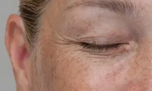 Primo piano del viso con occhio chiuso, rughe d'espressione e tante macchie di sole.