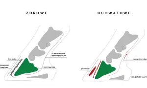 Zdrowe i ochwatowe kopyto konia. Ilustracja pokazuje rotację kości kopytowej i naciągnięte ścięgno w przypadku ochwatu.