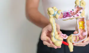 Model jelita z widocznymi zmianami, symbolizujący problemy z jelitem drażliwym.