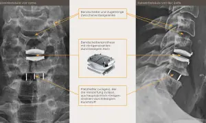 Röntgenbilder der Halswirbelsäule zeigen eine Bandscheibenprothese mit einem röntgendurchlässigen Kern und einem Platzhalter ("cage") für die hws versteifung.