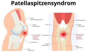 Illustration des Knies mit Hervorhebung des Schmerzpunktes an der Patellasehne, typisch für Patellaspitzensyndrom.
