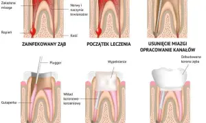 Ile naprawdę kosztuje leczenie kanałowe zębów i jak uniknąć wysokich rachunków
