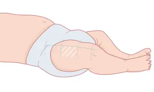 Illustration av ett barns lår med en ljusblå blöja. Markeringar på låret indikerar var 3 månaders vaccin ges.