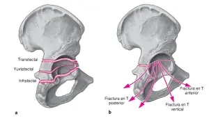 Ilustración de pelvis con fractura en rodete. A muestra tipos transtectal, yuxtatectal e infratectal. B muestra fractura en T anterior, posterior y vertical.