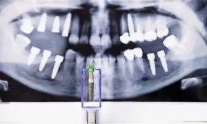 Implant dentystyczny w opakowaniu na tle zdjęcia rentgenowskiego szczęki z implantami. Obraz symbolizuje ryzyko odrzucenia przeszczepu kości pod implant.