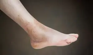 Noga po skręceniu: Kiedy ból minie i jak przyspieszyć gojenie?