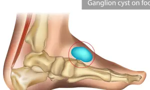 Anatomia stopy z widocznym ganglion na stopie, zaznaczonym czerwonym okręgiem.