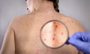 Plecy osoby dorosłej pokryte licznymi czerwonymi krostkami, widoczne pod lupą. To objawy różyczki u dorosłych.