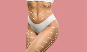 Co to liposukcja? Przewodnik po metodach, efektach i kosztach