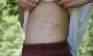 Piel con varias picaduras de pulgas rojas y elevadas en el costado.