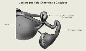 Illustration d'une ligature des trompes par voie chirurgicale classique, montrant l'utérus et une trompe de Fallope ligaturée et sectionnée.