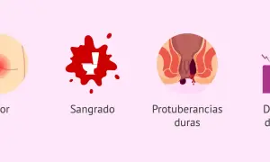 Síntomas de hemorroides postparto: picor, sangrado, protuberancias duras y dolor al defecar.