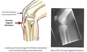 Ilustracja anatomiczna kolana z zaznaczonymi chorobami Osgooda-Schlattera i Sindinga-Larsena-Johanssona oraz RTG.