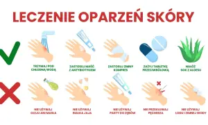 Porady dotyczące leczenia oparzeń skóry: chłodna woda, maść z antybiotykiem, zimny kompres, leki przeciwbólowe, aloes. Unikaj masła, jajka, pasty do zębów, przekłuwania pęcherzy i lodu.