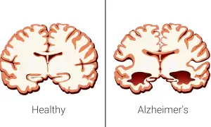 Porównanie mózgu zdrowego i z objawami choroby Alzheimera, która bywa nazywana cukrzycą typu 3. Widać zanik tkanki mózgowej.