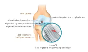 Anatomia kolana z zaznaczonym urazem ACL (przedniego więzadła krzyżowego). Widoczne pęknięcie więzadła.