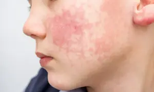 Visage d'enfant marqué par une rougeur diffuse et des plaques, symptômes d'une allergie pollen visage.