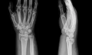Radiographies du poignet montrant une fracture. L'image de gauche est de face, celle de droite de profil.
